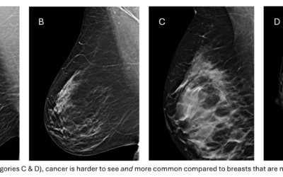 What Are Dense Breasts And Why Do They Matter?
